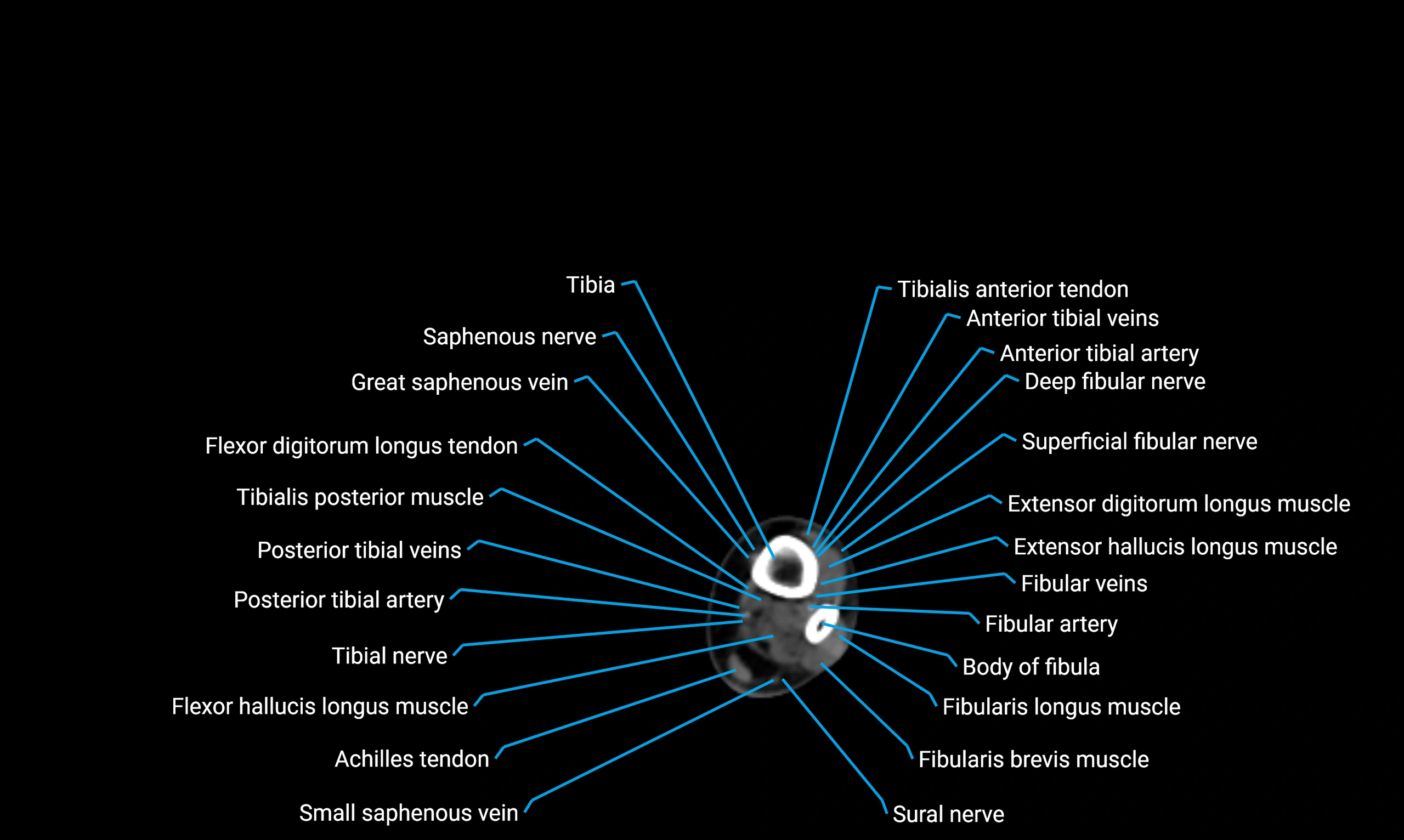 CT lower limb axial cross sectional anatomy labelled image 155 (2).webp